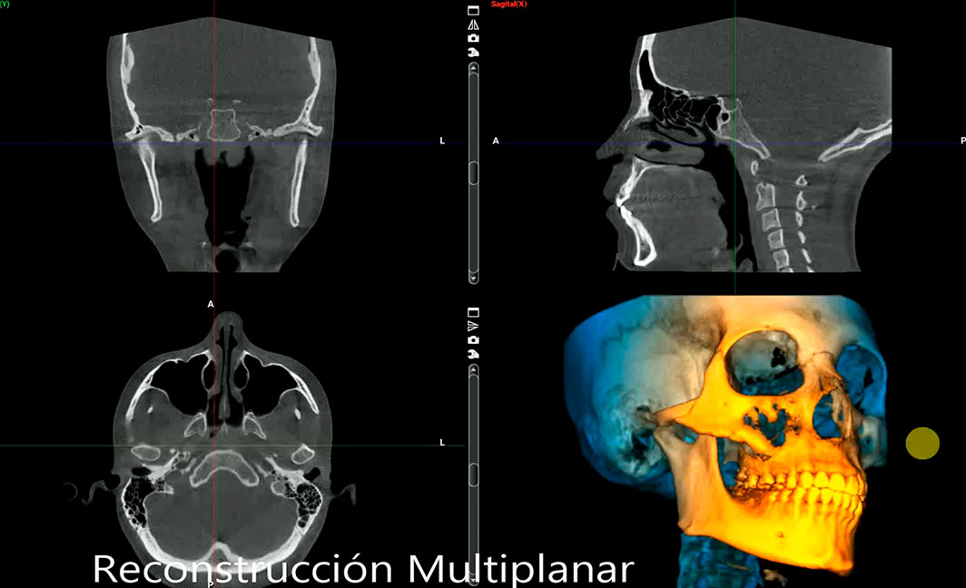Reconstruccion multiplanar